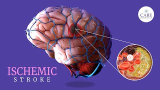 Ischemic Stroke Causes Symptoms Treatment amp Prevention  CARE Hospitals [upl. by Chilson]