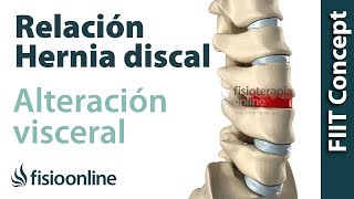 ¿Cómo se produce una hernia discal por una disfunción o alteración visceral [upl. by Langdon]