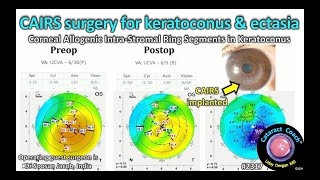 CataractCoach™ 2317 CAIRS surgery for keratoconus and corneal ectasia [upl. by Stortz]