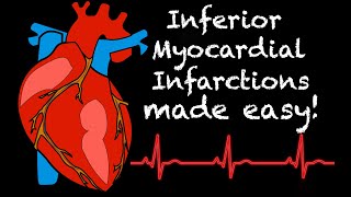 EMS Cardiology  Tachy Tuesday Inferior Myocardial Infarction STEMI [upl. by Hubsher]