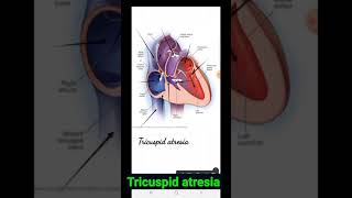 Tricuspid atresia [upl. by Akkinahs434]