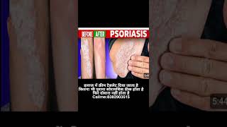 psoriasis treatment in Hindi [upl. by Cirdahc789]