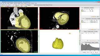 How to Include the Myocardium in Heart Models  Mimics Innovation Suite  Materialise Medical [upl. by Macrae785]