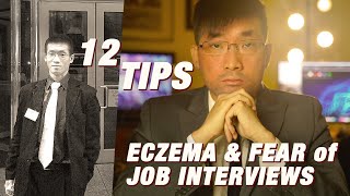 12 Tips for Eczema Anxiety at Job Interviews  Ep408 [upl. by Eledoya373]