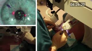 Realtime uncut unedited LASIK procedure live with real sound [upl. by Iarised565]