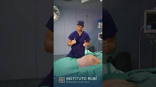 Cirugía plástica de lipoescultura con marcación abdominal [upl. by Fionna56]