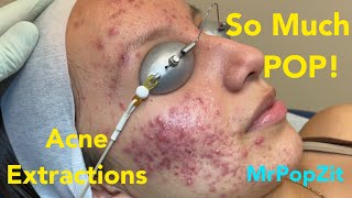 So much pop Acne extractions on severe inflammatory acne Multiple blackheads and whiteheads [upl. by Siraj]