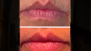 Lip filler  All on 6 implants  yay [upl. by Rodney50]