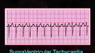 Introduction to EKG Rhythm Interpretation Part 3 [upl. by Akiras]