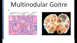 Pathology 810 a Goitre thyroid Multinodular adenomatous Plummer syndrome toxic [upl. by Rehpotsirk645]