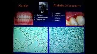 Santé versus Maladie de la gencive entamoeba gingivalis amibe [upl. by Rovert]