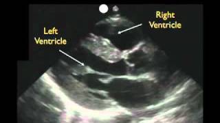 Cardiac Ultrasound  Parasternal Long Axis  Part 1  Sonosite Inc [upl. by Nettie]