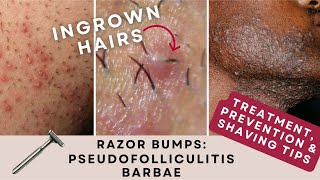 Razor Bumps Pseudofolliculitis Barbae  Prevention amp Treatment [upl. by Eillib]