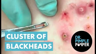 50 Minutes of Blackheads Clusters of Blackheads with Dr Pimple Popper [upl. by Larcher280]