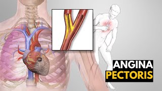 What is Angina Pectoris Causes signs and symptoms Diagnosis and treatment [upl. by Lliw905]