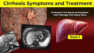 Liver Cirrhosis Symptoms and Treatment  Part1  Hepatitis  Liver Problem Symptoms  HealthWisdom [upl. by Zul]