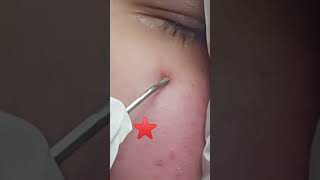 Spider Angioma Treatment l Spider Naevus l Spider Telangiectasia Learning of Doctors [upl. by Anned]