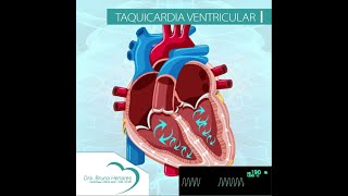 Taquicardia Ventricular [upl. by Erik147]