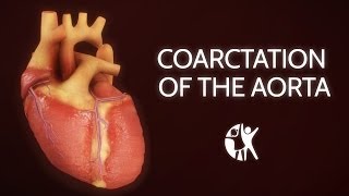 Coarctation of the Aorta [upl. by Talbott]