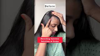 Receding hairline solution at homehair growth tipshairfall haircare hair shorts hairgrowth [upl. by Falito]