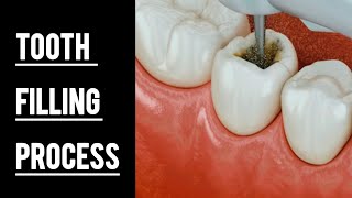 Tooth Filling or Cavity Filling process tooth dentalcare dentalclinic [upl. by Ella84]