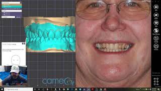 Smile Design 3D  Exocad [upl. by Mahgem39]