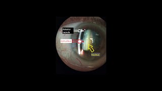 Slit lamp cataract assessment [upl. by Nehepts138]