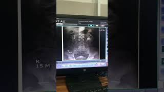 Fluoroscopy  fluoroscopy procedure  ivu procedure ivp procedure viral trending shorts [upl. by Rodney]