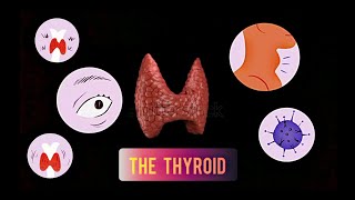 THYROID  HYPOTHYROIDISM Cretinism amp Myxedema [upl. by Zischke]