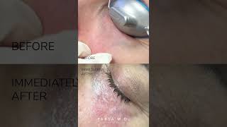 Laser Treatment for Purple amp Blue Veins Around the Eyes  Orbilase™ Treatment  Dr Kami Parsa [upl. by Etyak]