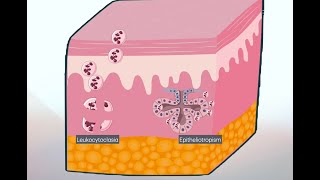 Virtual Pathology Walkthrough Neutrophilic Urticarial Dermatosis NUD [upl. by Eicrad]