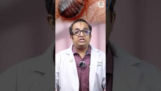 Bed Bugs ayurvedaindia doctor indianayurvedicdoctor ayurvediclife [upl. by Lamiv]