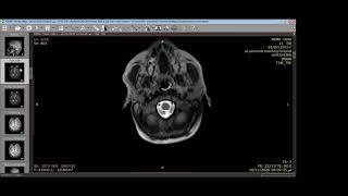 Oligodendroglioma [upl. by Edmon212]