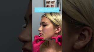 What are the benefits to Jawline filler 🫶🏼 [upl. by Atnima]