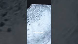 Molar pregnancy Hydatiform mole vesicular mole pregnancy youtubeshorts [upl. by Aliakam]