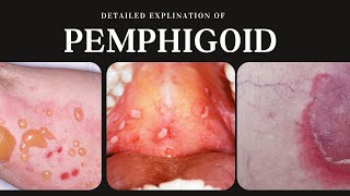 Pemphigoid Types Causes Clinical Presentation Diagnosis and Treatment [upl. by Annekahs]