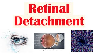 Retinal Detachment  Types Risk Factors Pathophysiology Signs amp Symptoms Diagnosis Treatment [upl. by Januarius925]