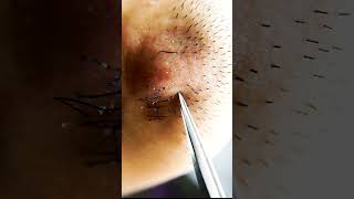 Super Satisfying Ingrown Hair Removal Ingrown Hair Removal 2022 Compilation29 shorts [upl. by Cinelli550]