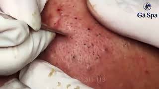 Blackheads 7750 [upl. by Enovahs]