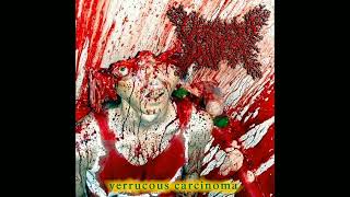 Viscera Infest  Verrucous Carcinoma 2015 Full Album [upl. by Hsirk]