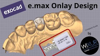 exocad emax Onlay Design [upl. by Enaols]