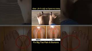 पैर के अंगूठे का टेढ़ापन का आसान इलाज गोखरु bunions HalluxValgus Treatment shorts [upl. by Lorien885]