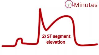 Understanding Myocardial Infarction STEMI ECG Evolution Explained [upl. by Scandura339]