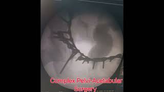 Complex PelviAcetabular Surgery  Dr Nikhil Verma complextrauma complexhipfracture acetabulum [upl. by Luisa973]