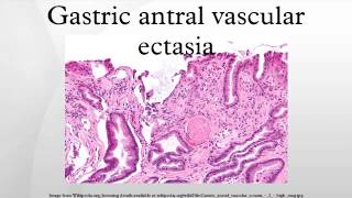 Gastric antral vascular ectasia [upl. by Anahc]