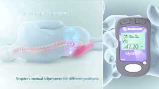 How Adaptive Stimulation Works [upl. by Niveek]