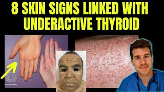 Doctor explains 8 SKIN SIGNS linked with HYPOTHYROIDISM aka underactive thyroid [upl. by Radborne]