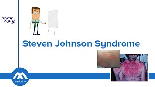 StevensJohnson Syndrome Causes Diagnosis Differentials Symptoms and Treatment [upl. by Aset]