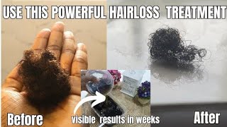 Dont Rinse OutOnly 3 ingredients to stop hair loss in weeks ALOPECIA AREATA TREATMENT [upl. by Anaeirb83]