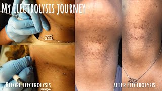 Electrolysis Update  permanent hair removal tweezing progress [upl. by Htims108]